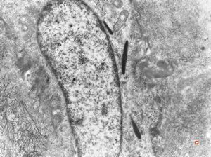 F, 61y. | malignant hemangioendothelioma of thyroid